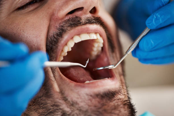Best Emergency Wisdom Teeth Removal in Royal Pines, NC