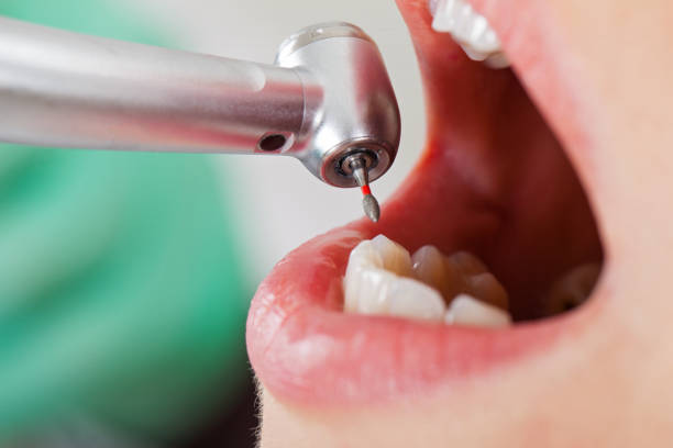 Best Emergency Dental Care for Broken or Chipped Teeth in Royal Pines, NC